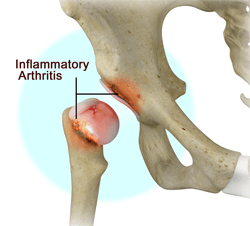  Inflammatory Arthritis of the Hip 