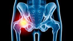  Hip Injury  