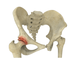  Osteoarthritis of the Hip 