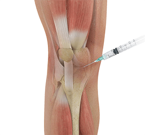 Intraarticluar Knee Injection