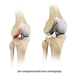 Non-Surgical Knee Treatments