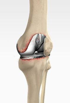 Painful or Failed Total Knee Replacement