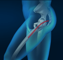  Posterior Hip Replacement 
