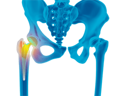  Revision Hip Replacement 