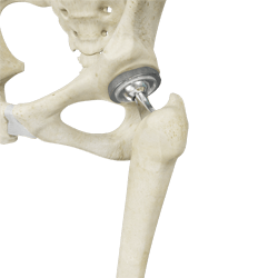  Total Hip Replacement 