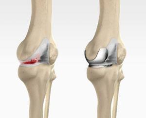 Unicondylar knee Replacement